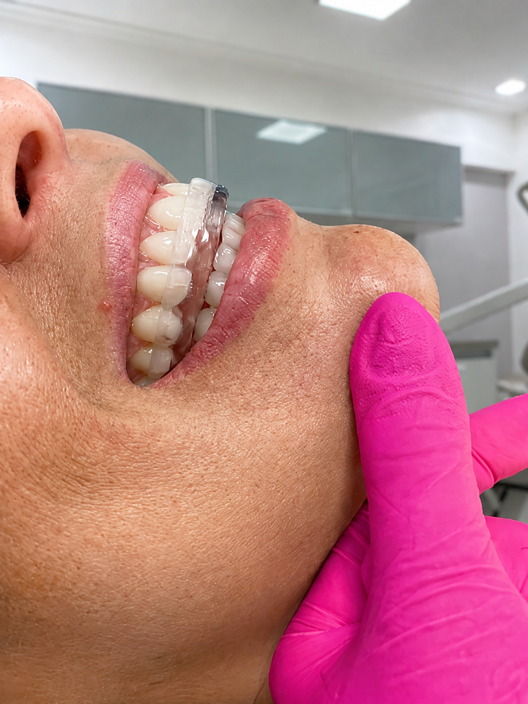 Detalhe de acompanhamento de um sorriso na Essenza
